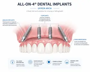 All-on-4 dental implants illustration showing full arch implant restoration