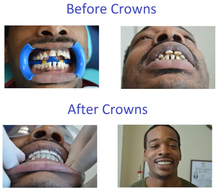 Before and after zirconia dental crowns smile transformation