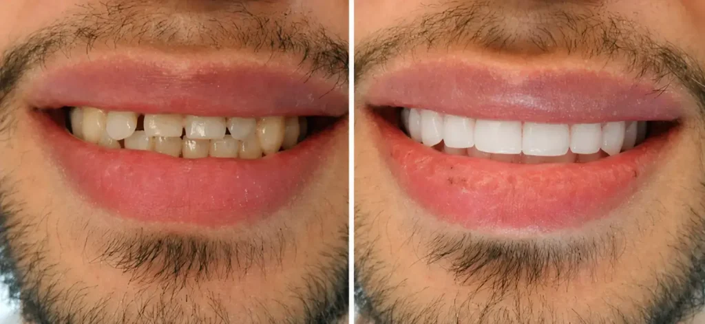 Before and after porcelain veneers smile makeover showing improved tooth color, shape, and overall smile aesthetics in Tijuana, Mexico.